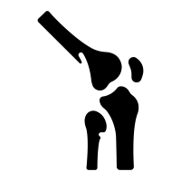 Meniscus Tear